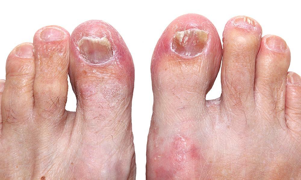 Fungal Infections