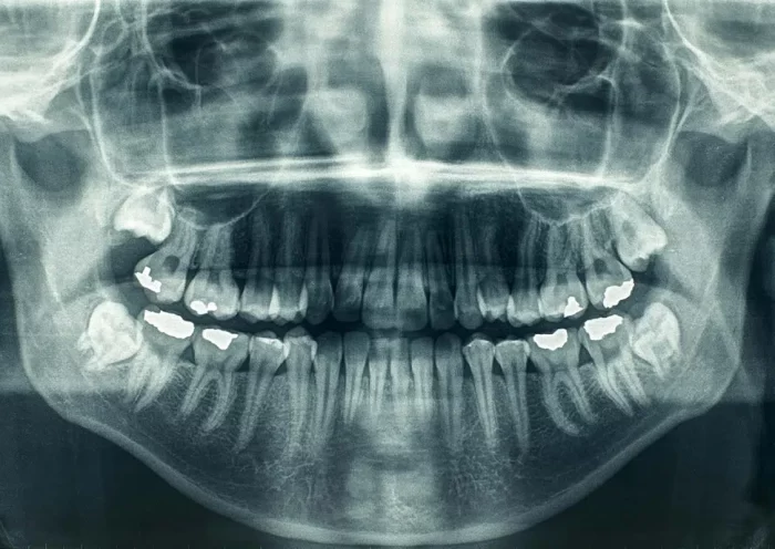 Dental X-Rays