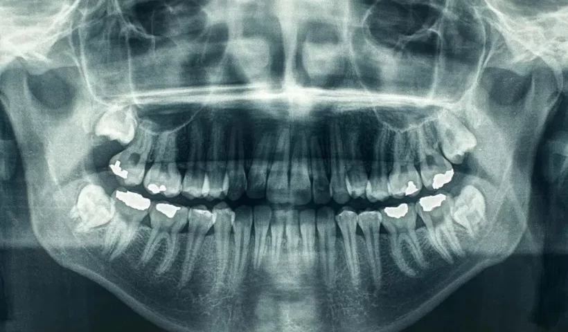 Dental X-Rays