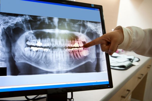 Dental X-Rays