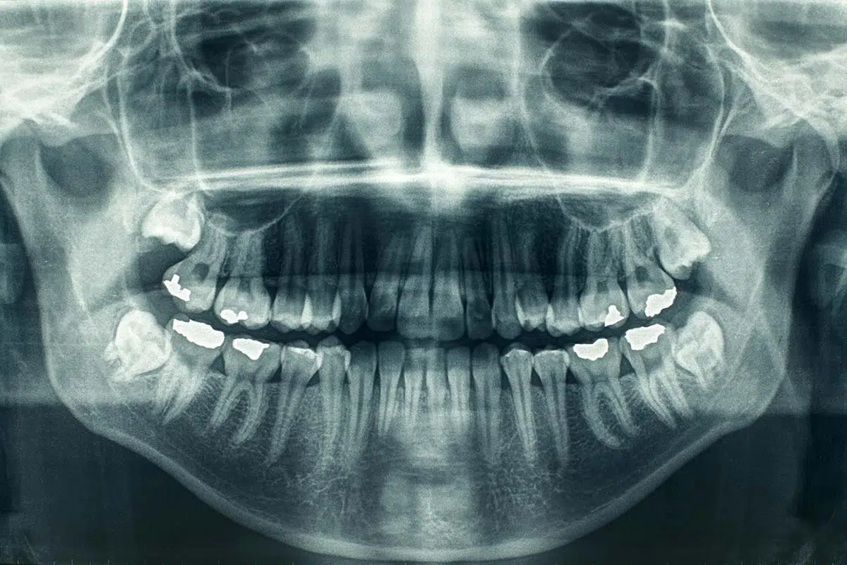 Dental X-Rays