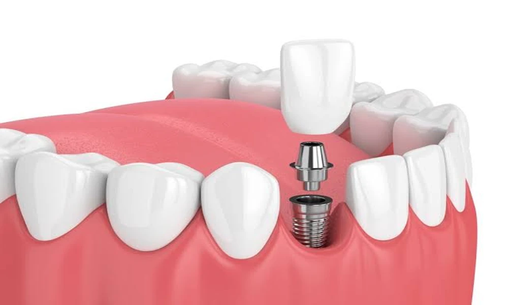 Dental Implants vs Traditional Tooth Replacement: Which Option Delivers Better Long-Term Value?