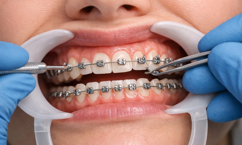 Orthodontic Treatment for Adults with Crowded Teeth and Bite Problems